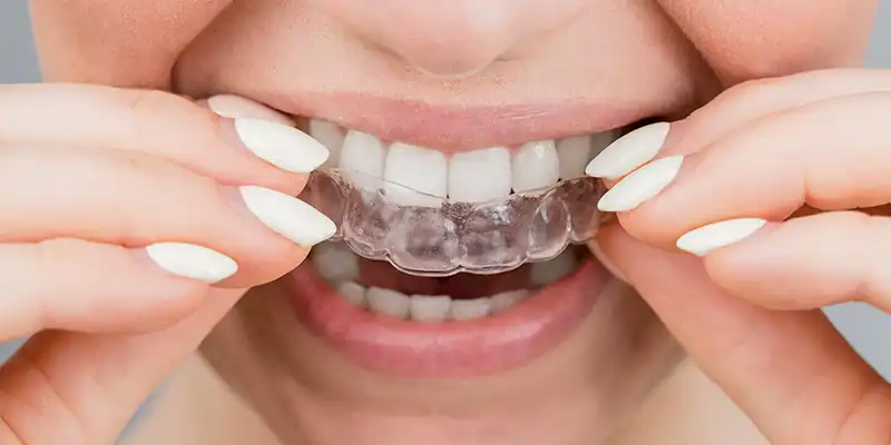 Mia Aligners - Getting Started